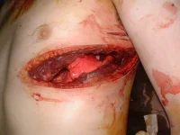 image02.gapping.wound.iraq.webp