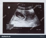 3 month fetus.jpg