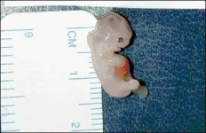 8WeekfetusRupturedTube.webp