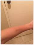 Michelle-Fields-bruise.jpg
